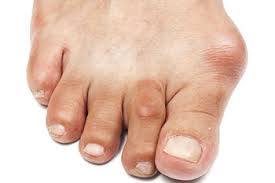 bunion